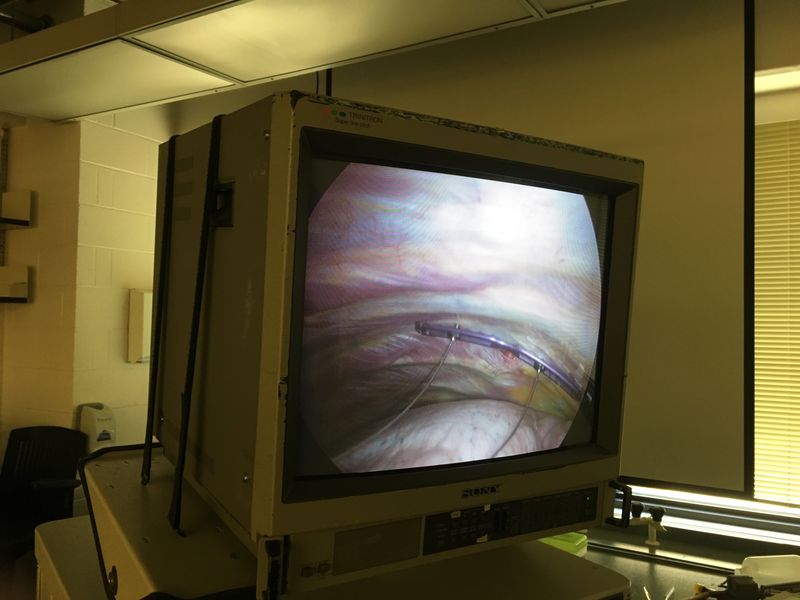 View from fiber-optic camera inserted into chest